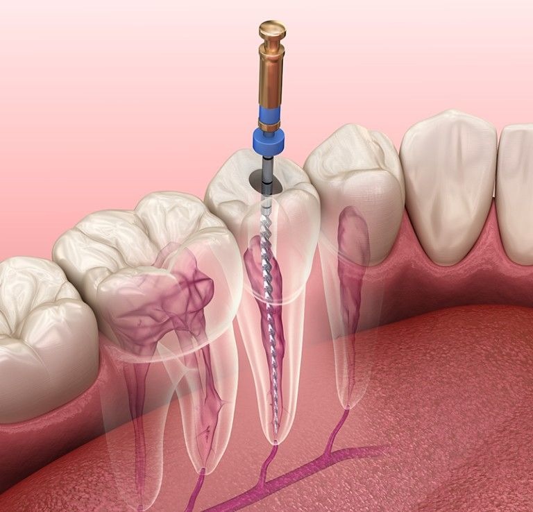 Endodonti (Kanal Tedavisi) ​2