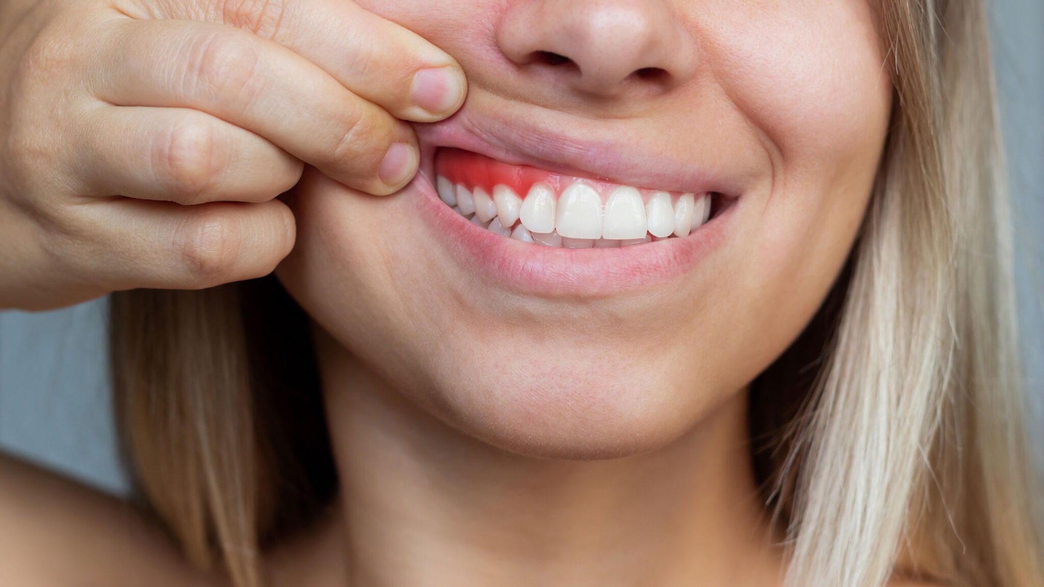 dis-eti-cekilmesi-belirtileri-20